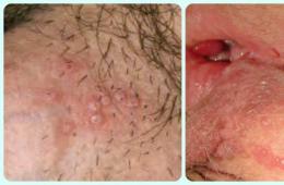 Šta je herpes simplex Herpes simplex tipovi 1 i 2